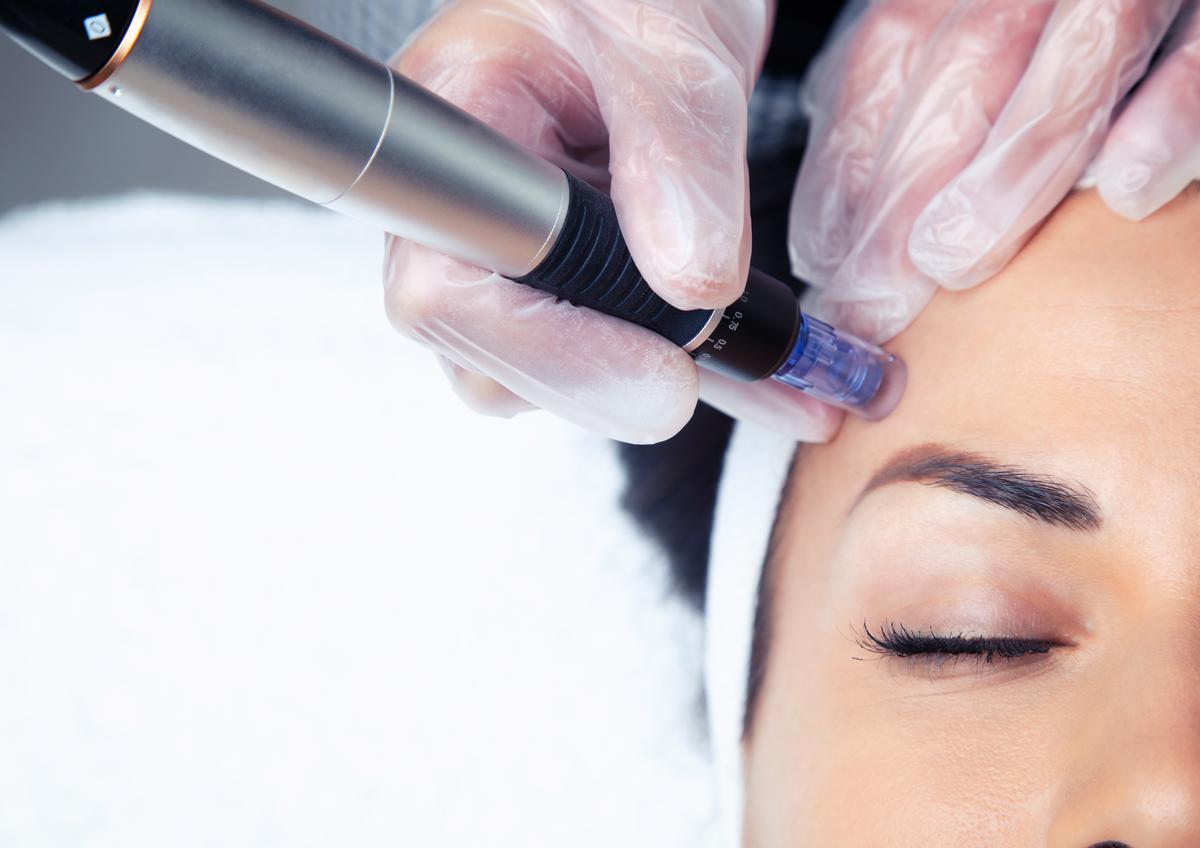 Microneedling à Genève