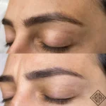 avant et après l'enlèvement du tatouage pmu - beauty art pro